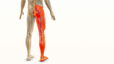 a photo that shows the sciatic v=nerve in the right leg, for the article Find relief from sciatica